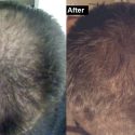 How I treated my hair loss