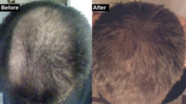 How I treated my hair loss