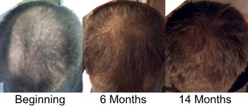 Results of Hair Loss Treatment