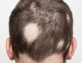Alopecia Areata on a man's scalp