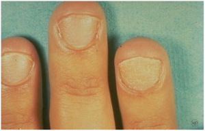 Alopecia Areata Fingernails