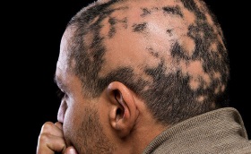 Alopecia Areata Side of Man's Head