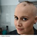 Woman with Alopecia Areata
