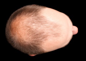 Typical Male Pattern Baldness