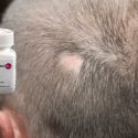 Ruxolitinib Alopecia areata cure
