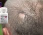Ruxolitinib Alopecia areata cure