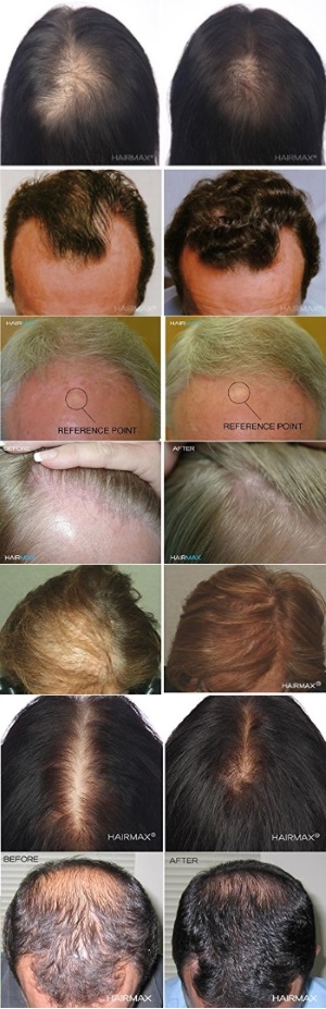 HairMax Laser Hair Growth Before After