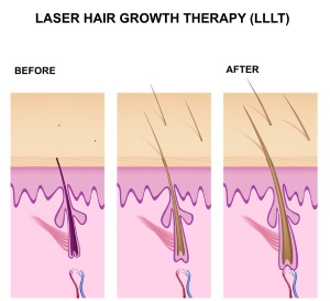 Does Laser Hair Growth Really Work?
