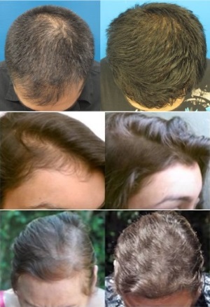 Theradome LH80 Laser Hair Growth