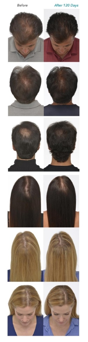 iGrow Laser Hair Growth Before After Pictures