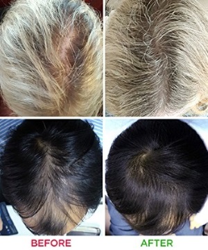 iRestore Laser Hair Growth Before After Pictures